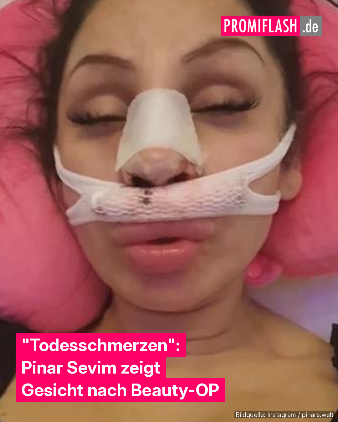 Todesschmerzen": Pinar Sevim zeigt Gesicht nach Beauty-OP